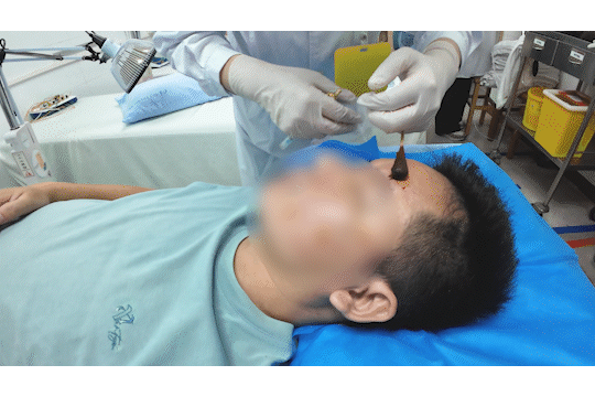 醒来“天塌了”！深圳一女子眼睛闭不上、嘴巴漏水！这些错误很多人会犯