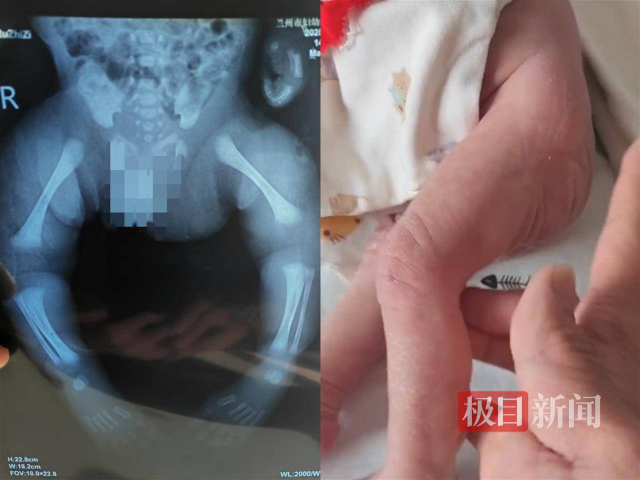 二胎出生查出先天性病症或落下残疾，残疾父母称医院产检漏检、未尽告知义务，医院及医调委回应