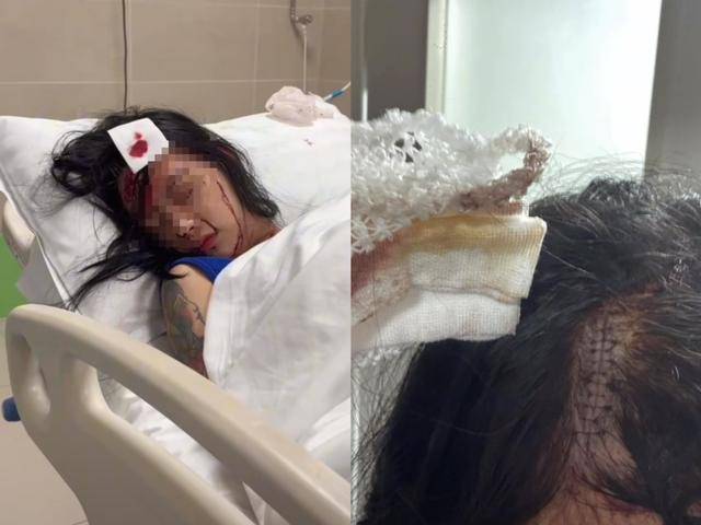 女子被闺蜜酒后用菜刀砍伤头部，警方：行政拘留10天