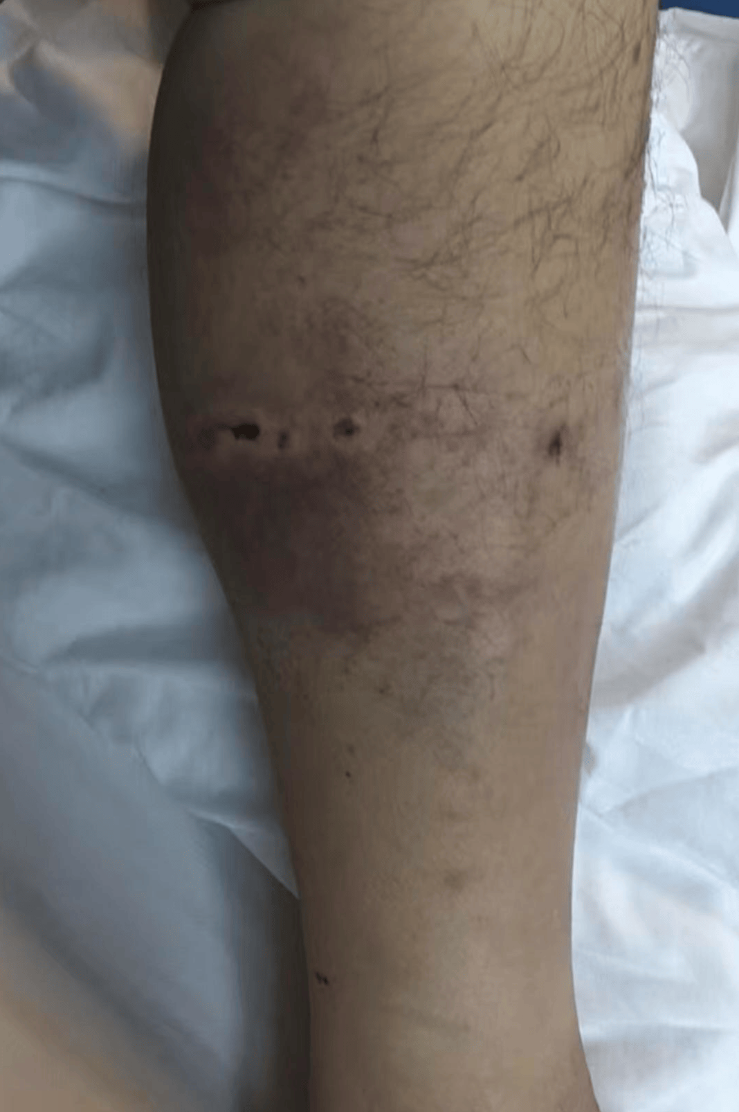 重庆男子上山采菌正面遇黑熊袭击，当事人：小腿被咬，穿的水鞋救了我一命；遭一掌打下山坡后险坠山崖幸被树枝拦住，醒后找到手机求救