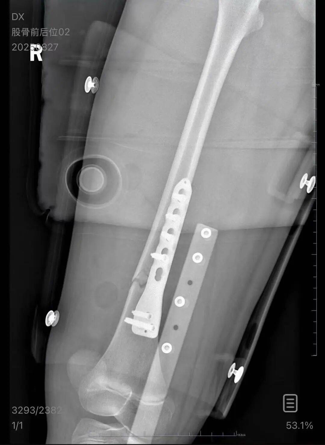 男子火车上铺跌落砸断10岁女孩腿骨，回应“失联”称失业讨薪中