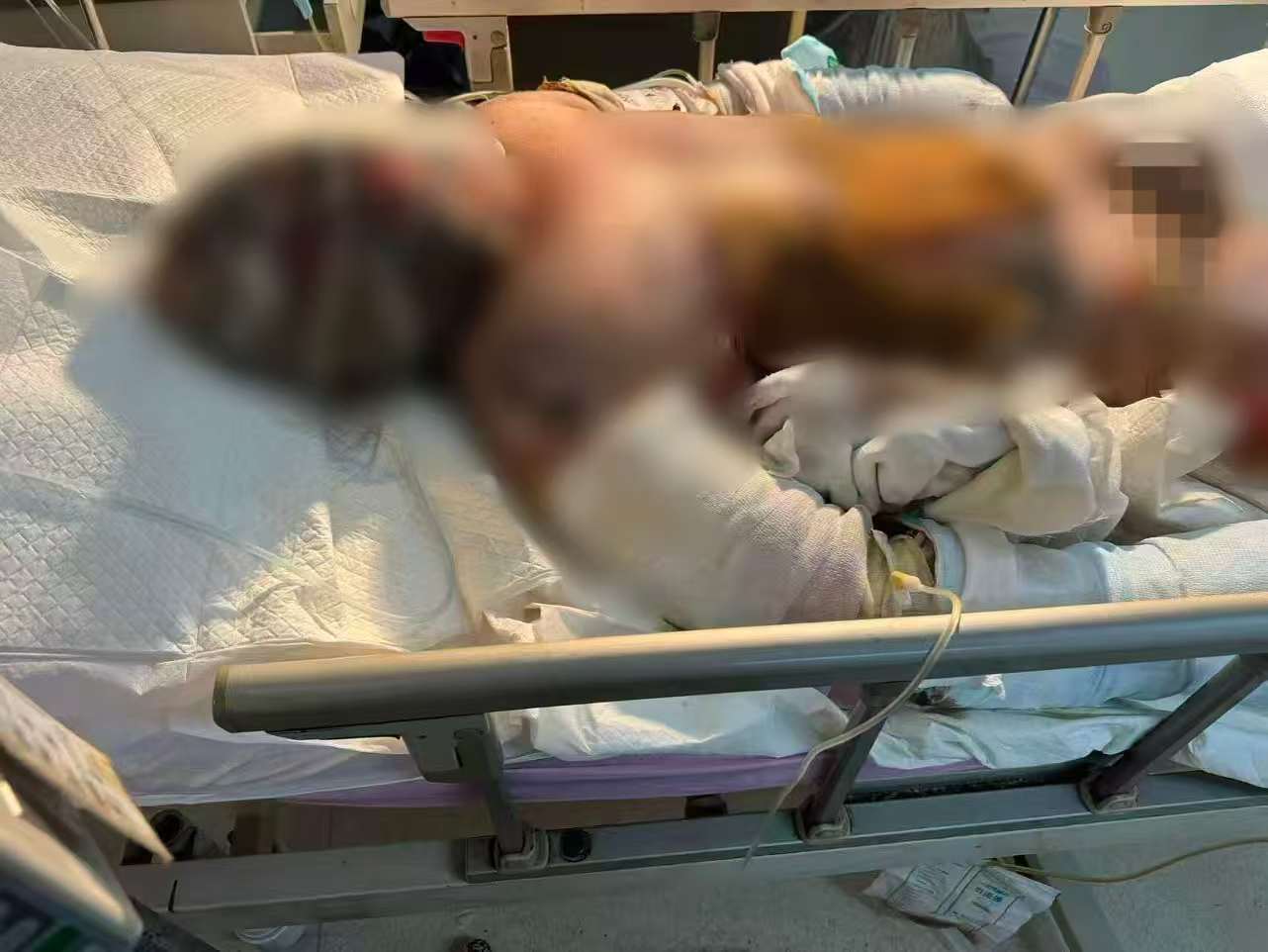 父子在哈尔滨一亲戚公司上班遇爆炸全身烧伤，治疗花费近百万公司拒赔偿？亲戚回应